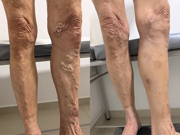 Caso clínico 1 — antes e depois do tratamento de varizes