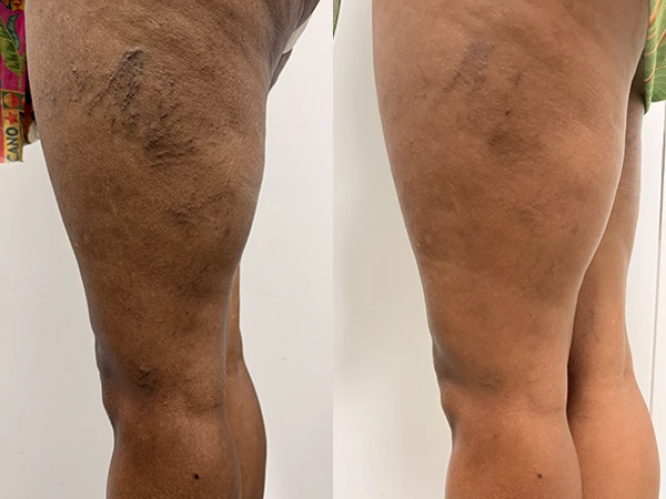 Caso clínico 2 — antes e depois do tratamento de varizes
