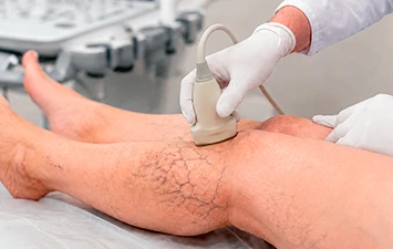 Doppler vascular — exame de ultrassom
