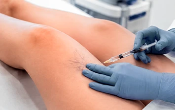 Escleroterapia — procedimento vascular