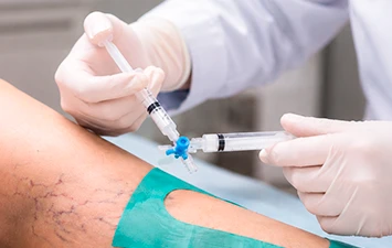 Tratamento com espuma — procedimento vascular