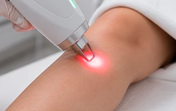 Laser transdérmico — tratamento de vasinhos