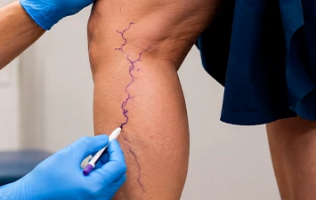 Microcirurgia de varizes