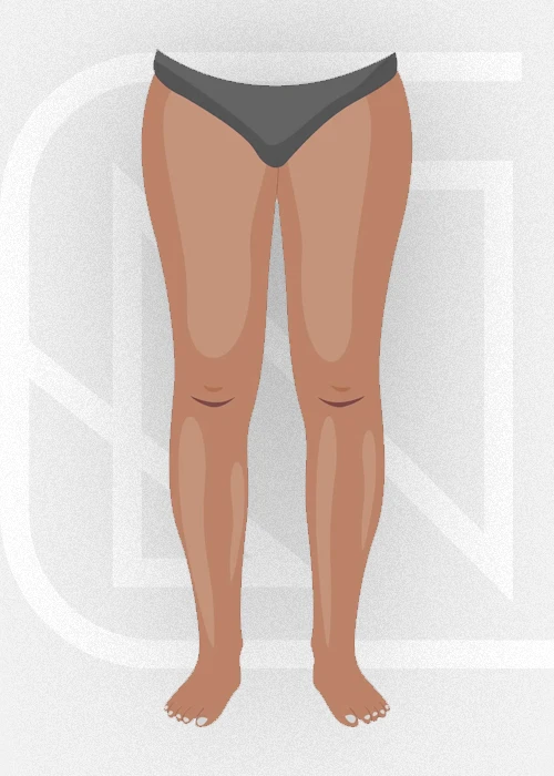 Lipedema • Estágio 1