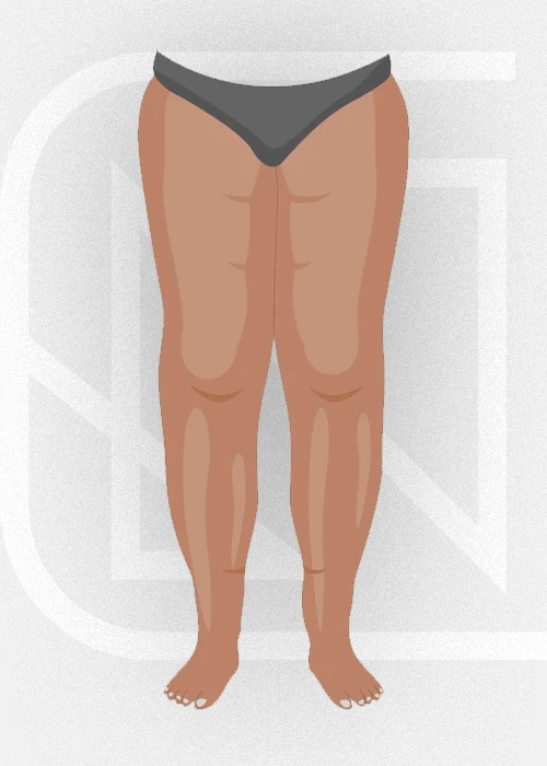 Lipedema • Estágio 2