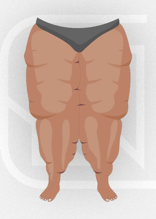 Lipedema • Estágio 4